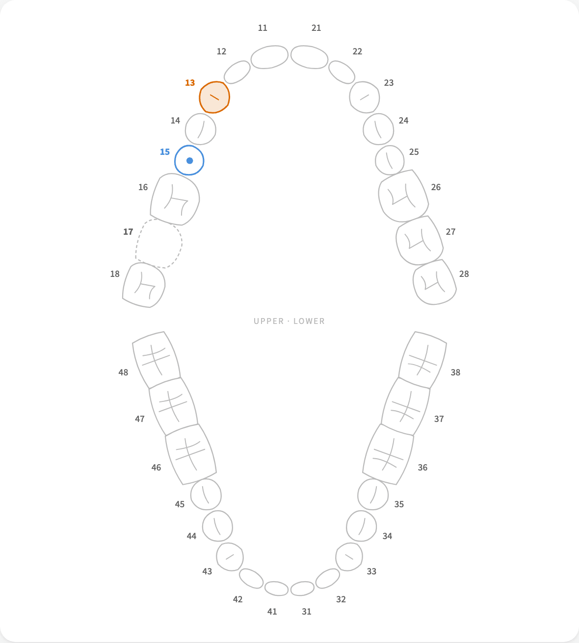 The dictated state: tooth 13 has decay, 15 has a filling, 17 is missing.